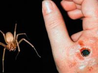 picadura de araña violinista